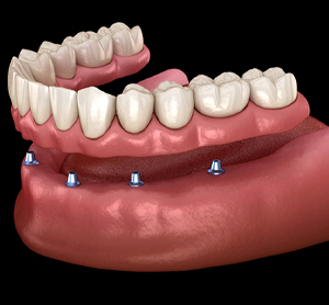 dental implant snaps denture