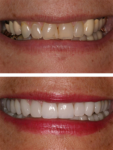 Smile before and after dental treatment