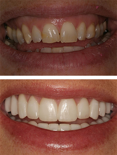Dull teeth before treatment and brighter teeth after