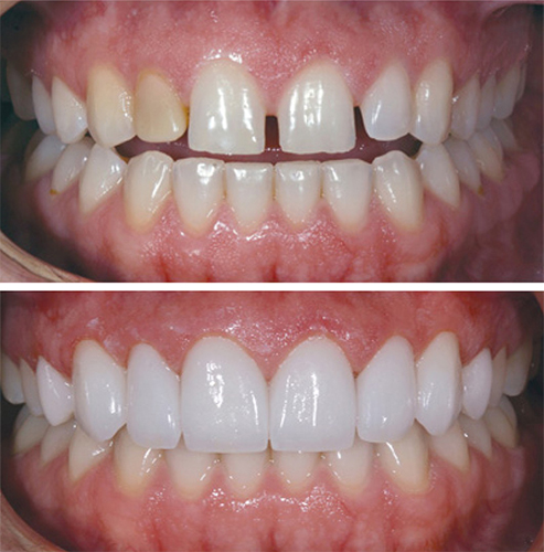 Smile before and after teeth have been restored