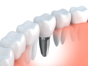 Dental implants from dentists in Burleson, Drs Oza and Kohli, replace teeth beautifully and securely. Who is a candidate for these prosthetic wonders?