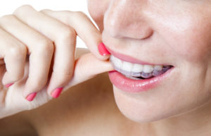 Invisalign aligners in Burleson are clear and removable