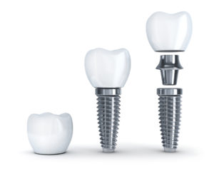 Dental implants in Burleson make the jaw bone strong.