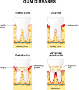 Your dentist in Burleson provides gum disease treatment.