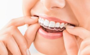 Is Invisalign Right For Me? | Marvel Dental Burleson