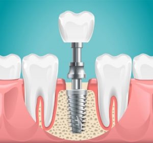 Image of a dental implant replacing a missing molar.