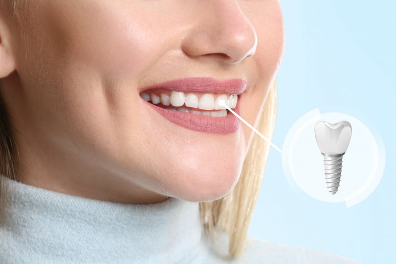 A closeup of a woman’s smile highlighting her implanted tooth