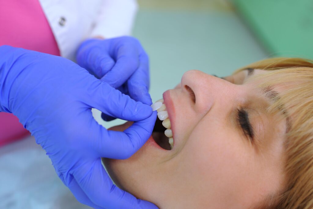 Dentist with blue gloves placing veneers on blond patient's teeth