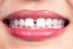 Close up of patient’s dental gap
